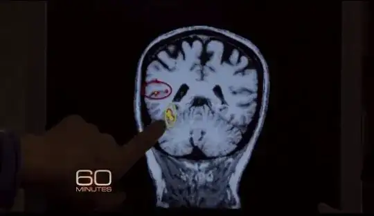 Image of a MRI scan of a patient with Prosopagnosia