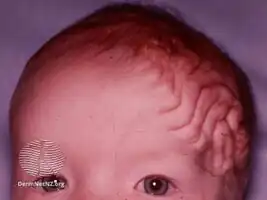 Cutis verticis gyrata