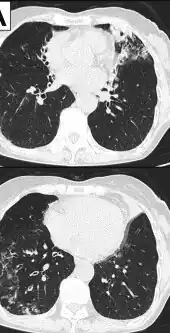 Image indicate bronchodilation, centrilobular granular shadow, and consolidation
