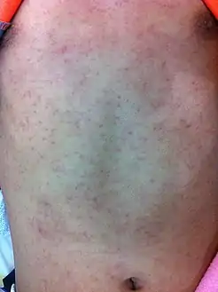 Chikungunya  abdomen