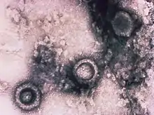 Colorized transmission electron microscopic (TEM) image, from a pelleted specimen, depicts three icosahedral-shaped herpes virus particles. The staining technique reveals virions with a dark center, where the stain has penetrated, indicated a capsid with no DNA, while a virion with a light center, where there was no stain penetration, indicated a nucleocapsid, consisting of a capsid, plus its DNA core.