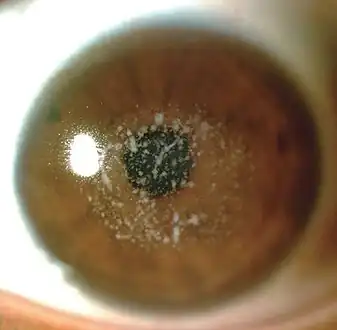 Granular corneal dystrophy type I