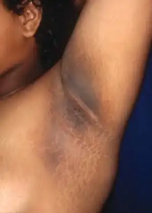 Acanthosis nigricans