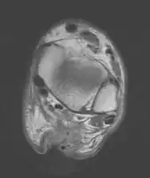 Transverse plane/Achilles tendon rupture