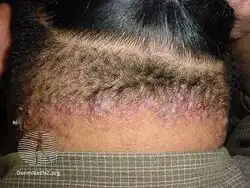 Acne keloidalis