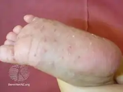 Acropustulosis of infancy