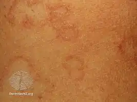 Actinic granuloma