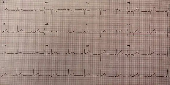 ECG showing slight ST elevation in many leads congruent with pericarditis