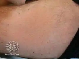 Alopecia mucinosa