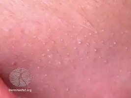 Alopecia mucinosa