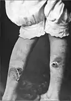 Erythema induratum