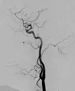 Angiogram