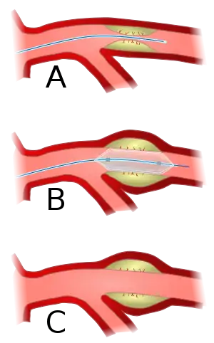 Angioplasty (pictured) and stenting are two endovascular treatments employed by the vascular surgeon.