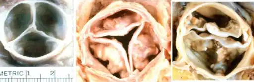 Non‐mineralised tricuspid aortic valve (left) and stenotic mineralised tricuspid (middle) and bicuspid (right) aortic valves.
