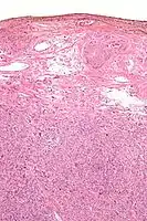 Micrograph showing a silver nitrate (brown) marked surgical margin.