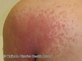 Autoeczematization