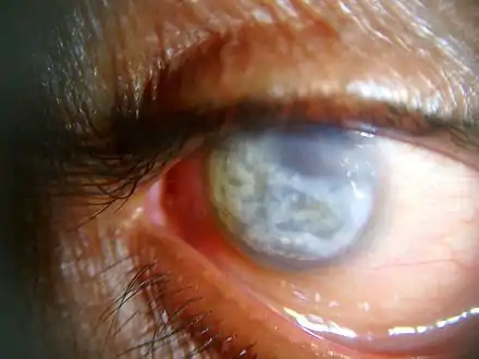 Band keratopathy of a 60-year-old male