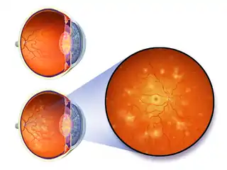 Illustration depicting diabetic retinopathy