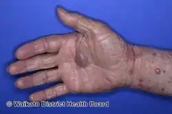 Bullous pemphigoid induced by pembrolizumab