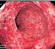 Endoscopic biopsy showing granulomatous inflammation of the colon in a case of Crohn's disease.
