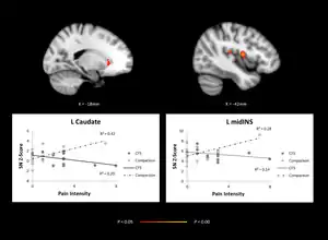 Brain imaging, comparing adolescents with chronic fatigue and healthy controls showing abnormal network activity in regions of the brain.