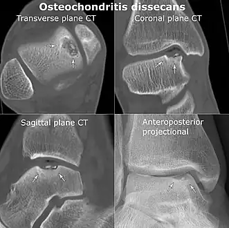 CT scan and projectional radiography of a case of osteochondritis dissecans of parts of the superio-medial talus.