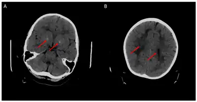 Cerebral CT-scan at 4 years old. Red arrows show brain calcifications (A) and diffuse white matter abnormalities (B). From Mafi et al., 2020