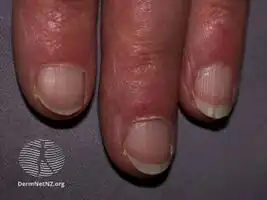 Chilblain lupus