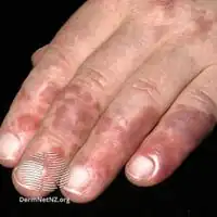 Chilblain lupus