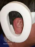 Chondrodermatitis nodularis helicis protector