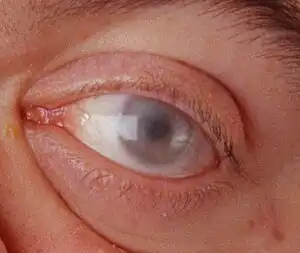 Corneal clouding in a 30-year-old male with MPS VI. Morquio syndrome and other MPS disorders may also present with corneal clouding
