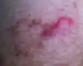 Cutaneous larva migrans