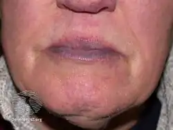 Cyanosis
