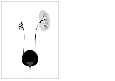 Cystic dysplasia - can affect one or both kidneys