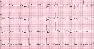 ECG showing HOCM
