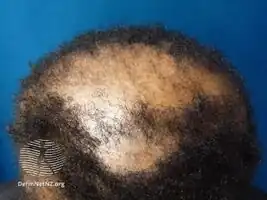 Central centrifugal cicatricial alopecia