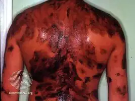 Coal tar/treatment
