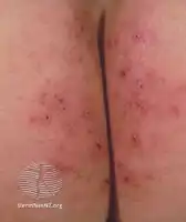 Dermatitis herpetiformis