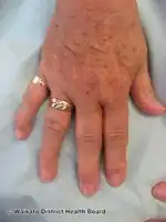Diabetic stiff skin