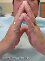 Diabetic stiff skin