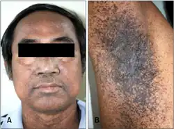 58-year-old son with Dowling-Degos disease