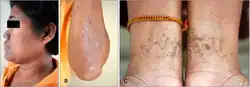 50-year-old daughter with Dowling-Degos disease
