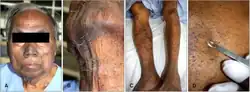 82-year-old father with Dowling-Degos disease