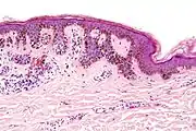 Micrograph of a dysplastic nevus showing the characteristic rete ridge bridging, shouldering, and lamellar fibrosis. H&E stain.