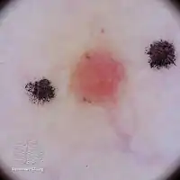 Eccrine poroma