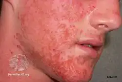 Eczema herpeticum