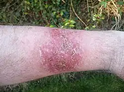 Effect of topical skin treatment with 5-fluorouracil cream after 30-day, before commencement of the healing phase (months two and three)