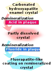 Carbonated hydroxyapatite enamel crystal is demineralized by acid in plaque and becomes partly dissolved crystal. This in turn is remineralized by fluoride in plaque to become fluorapatite-like coating on remineralized crystal