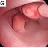 Recurrence after removal