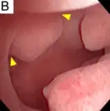 Sessile endometrial polyp